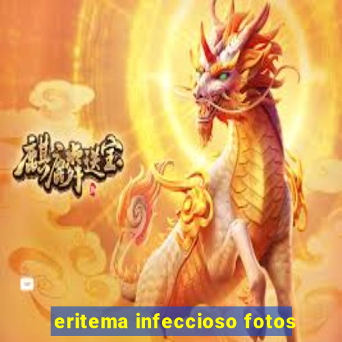 eritema infeccioso fotos